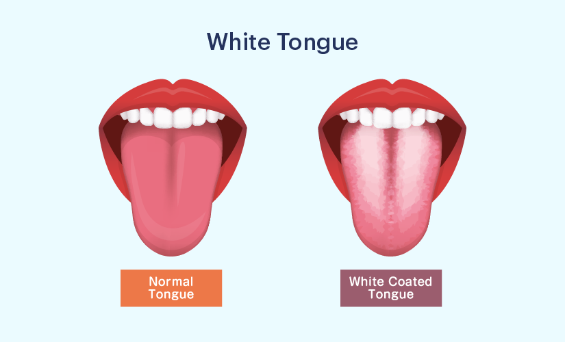 White tongue outlet thrush